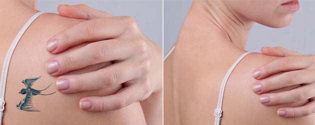 Laser Tattoo Removal Treatment