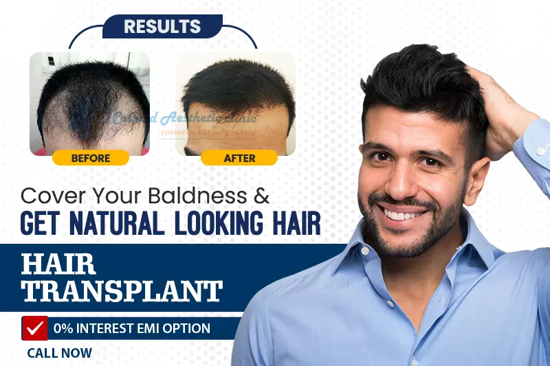 Hair Transplant in Thane, Mira Road