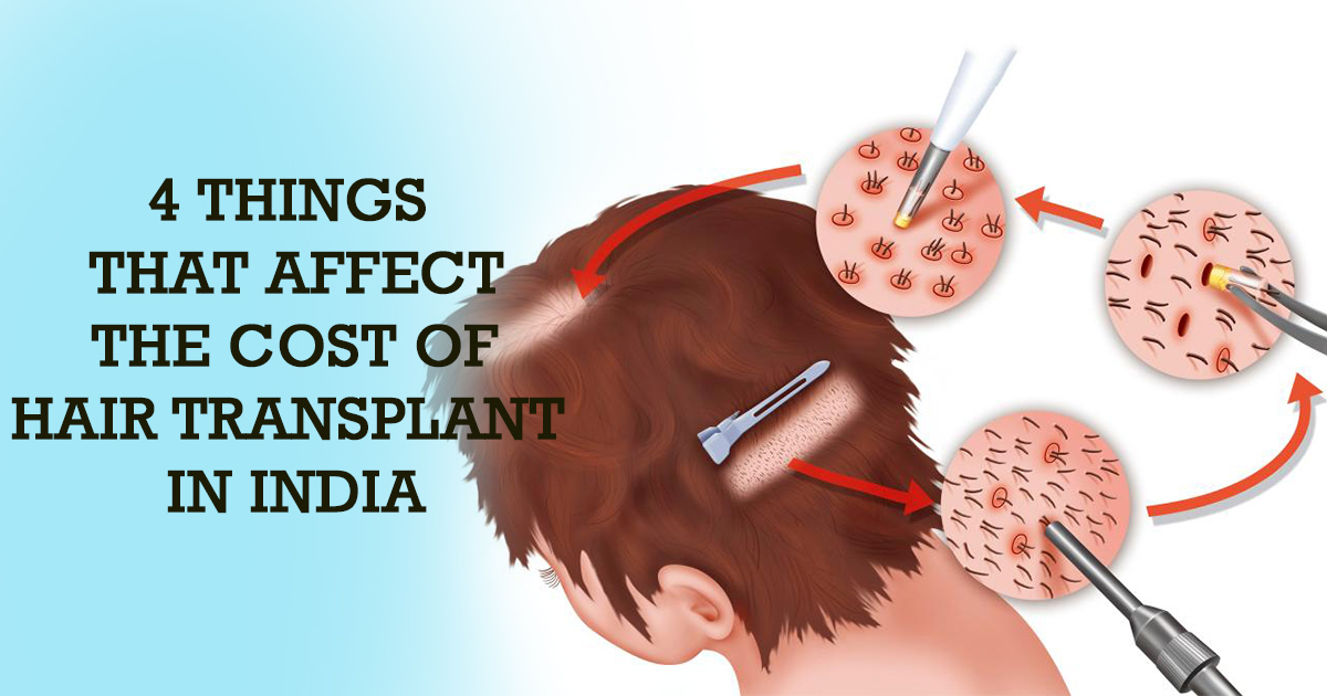 4 Things that Affect the Cost of Hair Transplant - Cosmed Clinic 4 Things that Affect the Cost of Hair Transplant - Cosmed Clinic