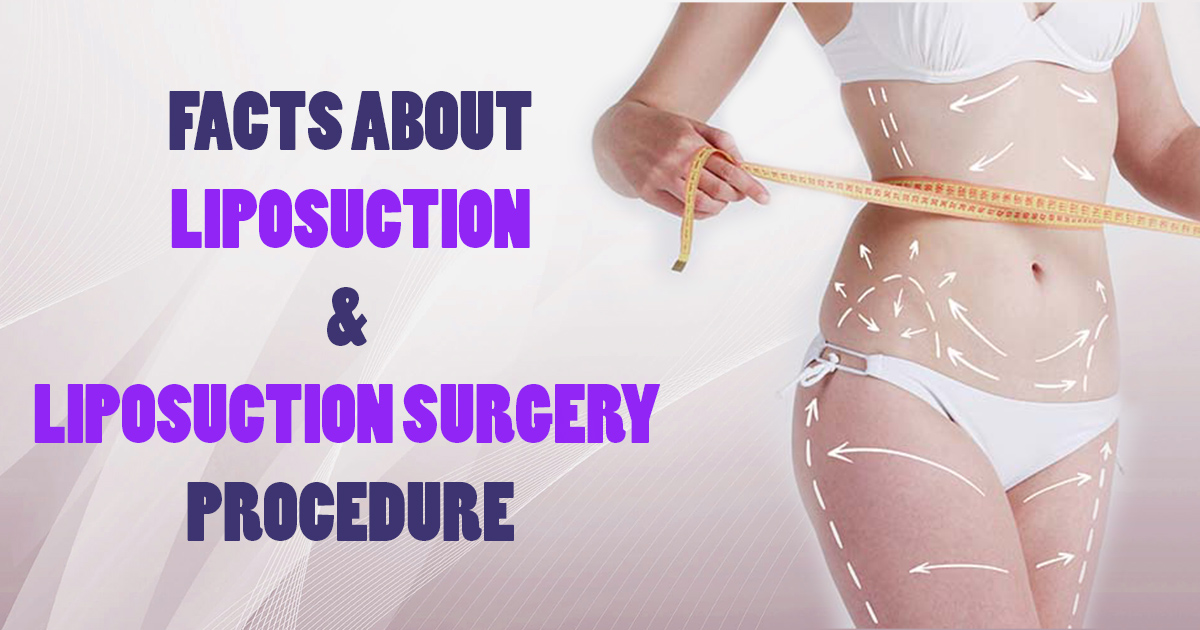 Liposuction Surgery Procedure