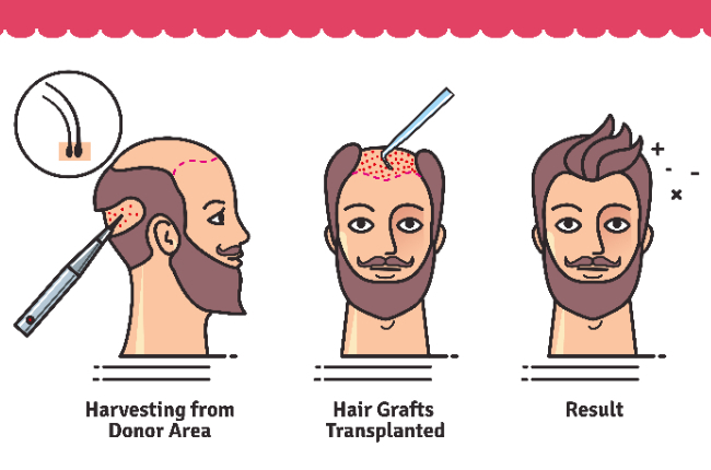 Say No to Baldness with Hair Transplant Surgery