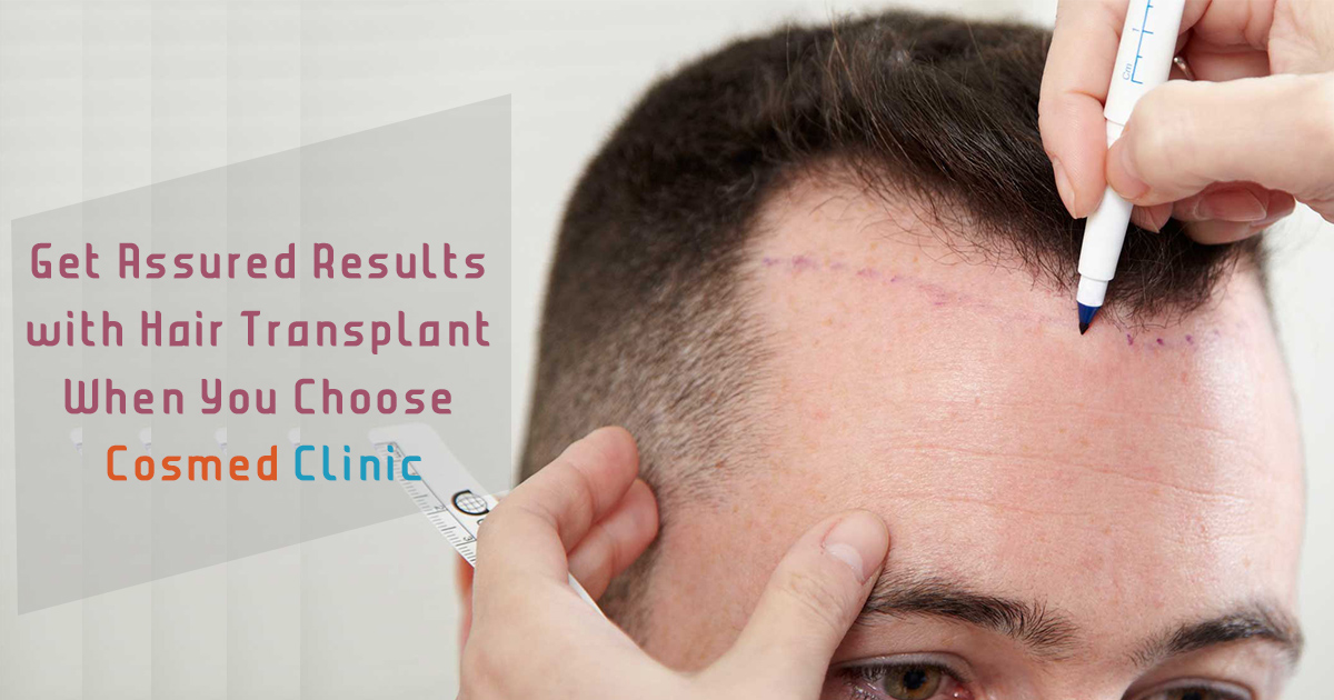 Hair Transplant at Cosmed Clinic