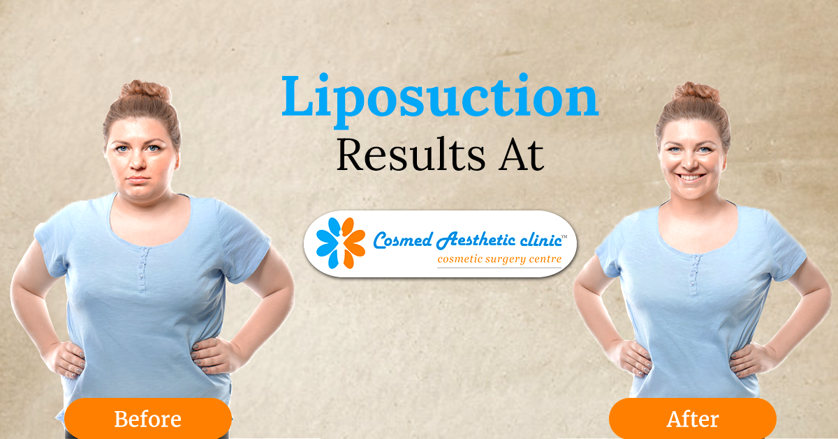 Liposuction