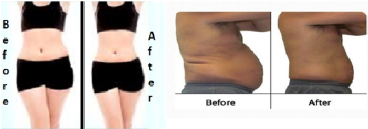 Liposuction Surgery Results