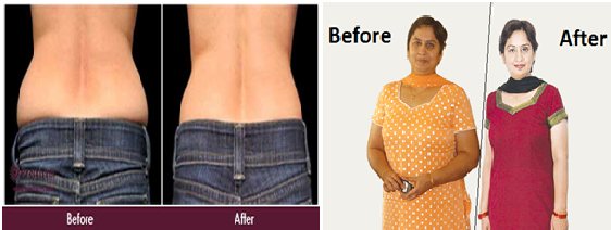Liposuction Before and After