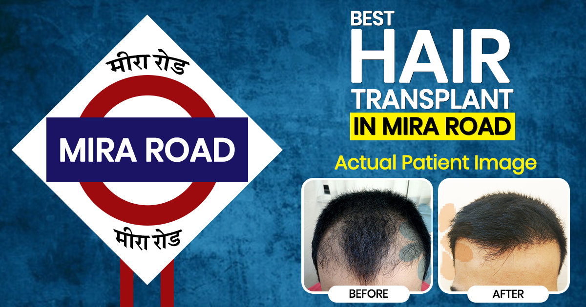 Best Hair Transplant in Mira Road | Cosmed Clinic Best Hair Transplant in Mira Road | Cosmed Clinic